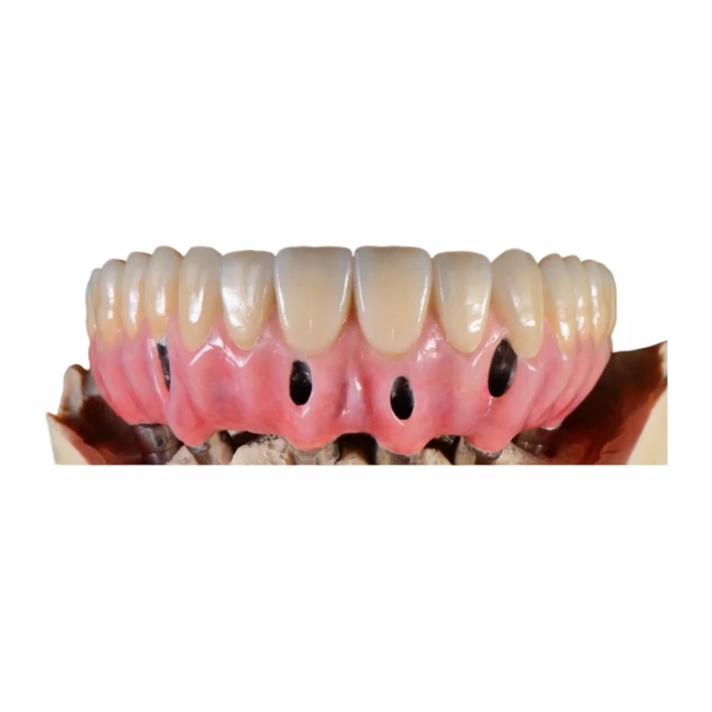 All-on-4 Full Arch Implant Malo hibrid híd